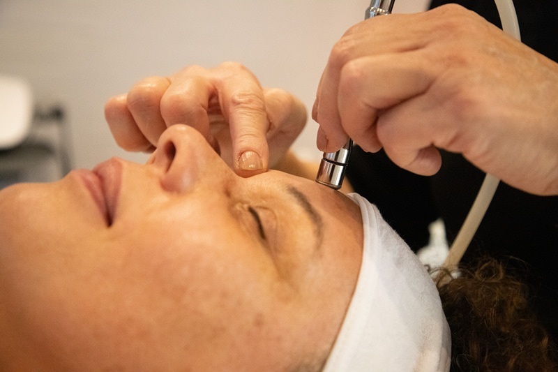 diamantslibning-ansigt-1m Kvinde får udført microdermabrasion (diamant slibning) i panden i Næstved.