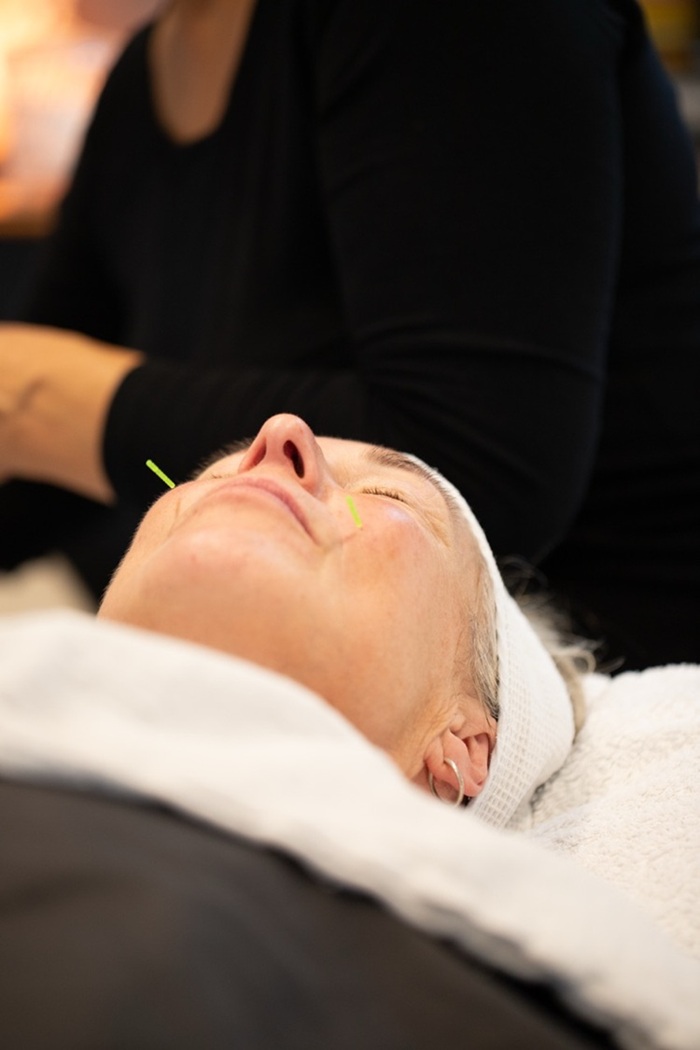 Kvinde med nåle i annsigt. Kosmetisk akupunktur (ansigtsakupunktur) i Næstved, Sydsjælland.