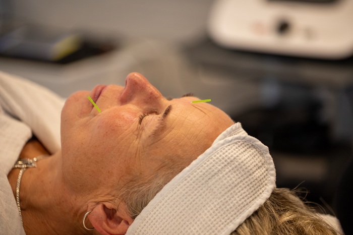 Lene Kryger giver kosmetisk ansigtsakupunktur. Kosmetisk akupunktur Næstved. Naturli' Behandling.